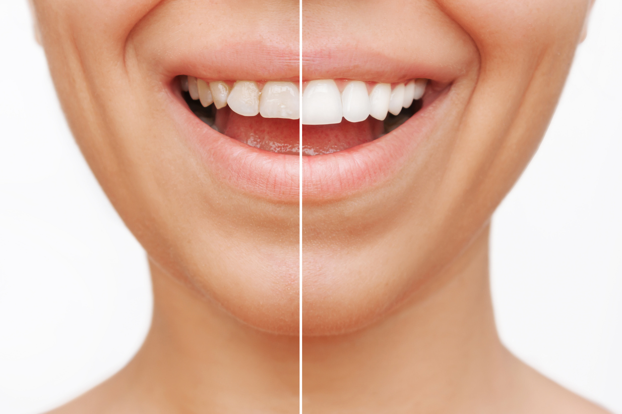 Featured image for What To Expect From Dental Veneers